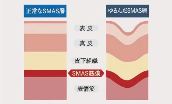 SMAS筋膜